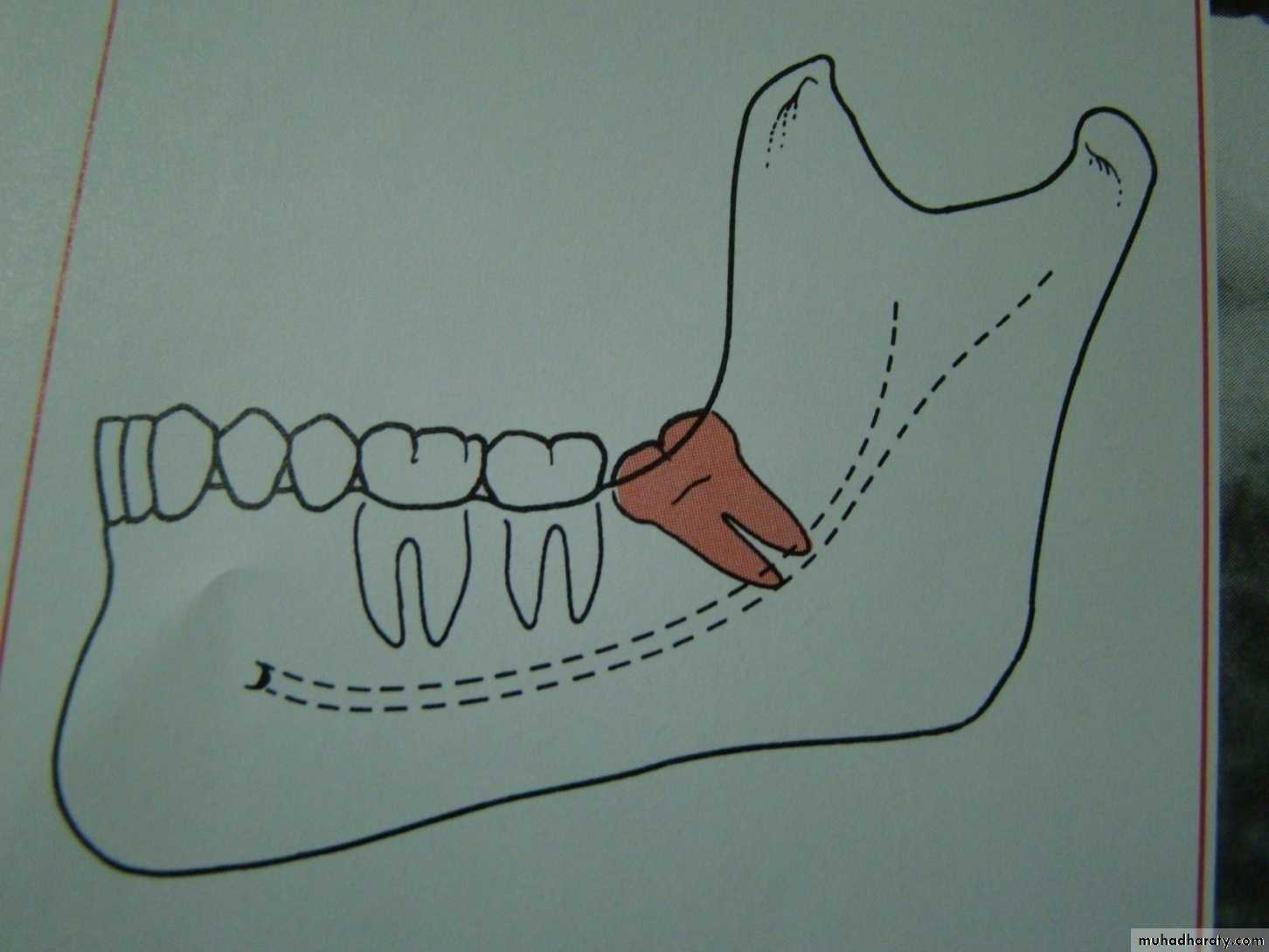 Impaction