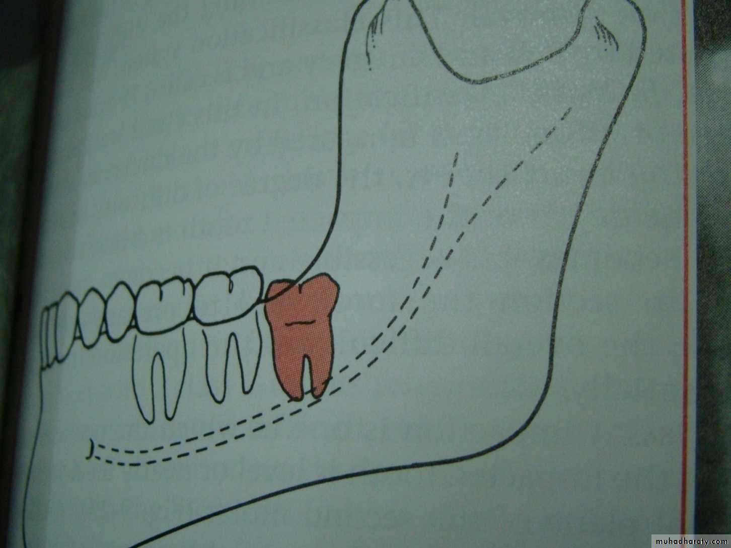 Impaction