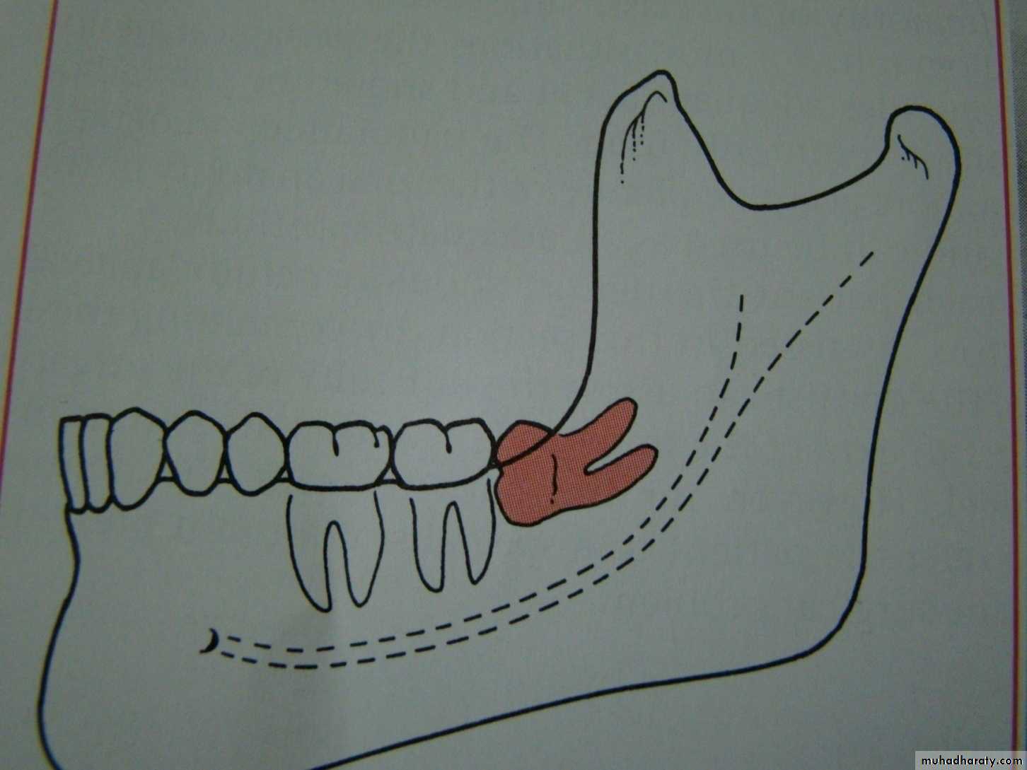 Impaction