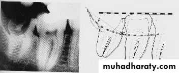 Impaction