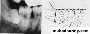 Impaction