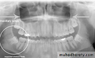 Impaction