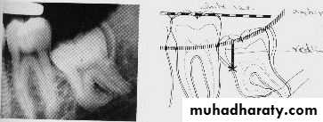 Impaction