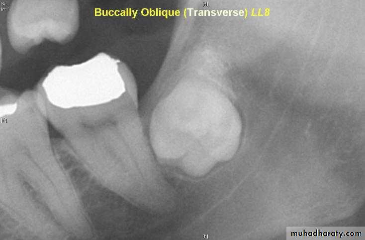 Impaction