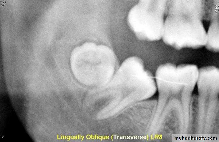Impaction
