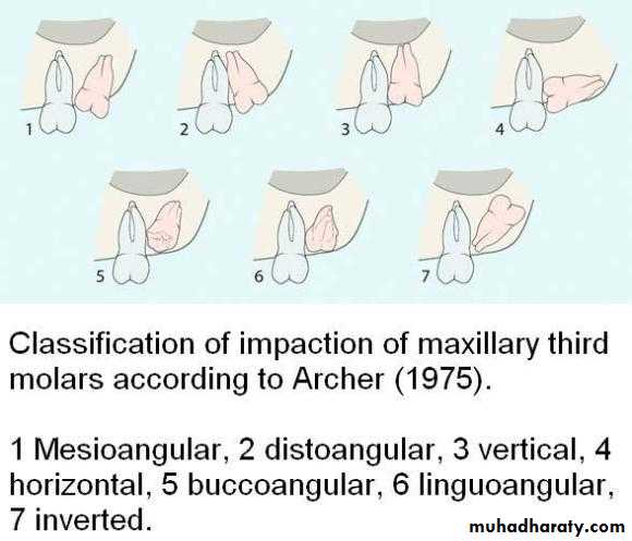 Impaction