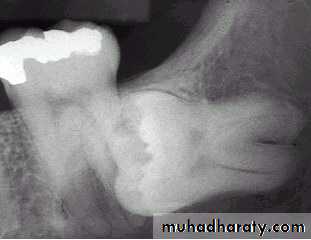 Impaction