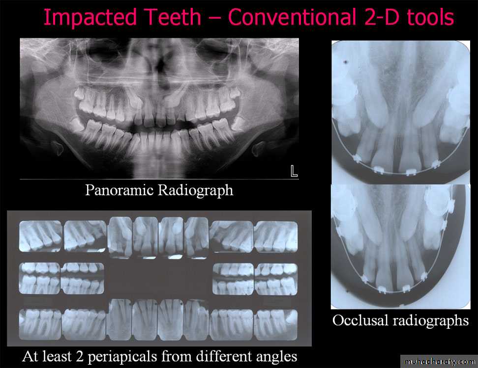 Impaction
