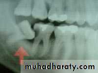 Impaction