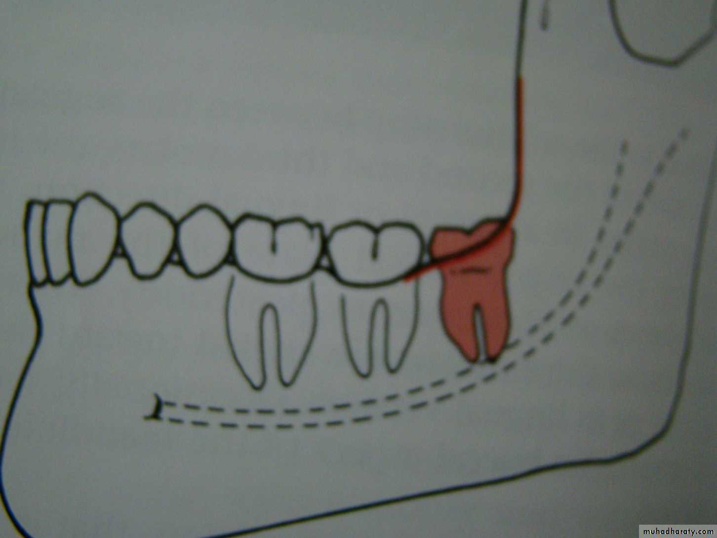 Impaction