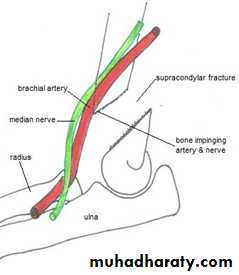 fracture around the elbow in childrin