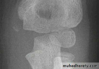 fracture around the elbow in childrin