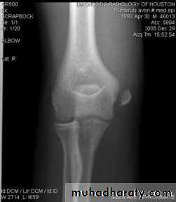 fracture around the elbow in childrin