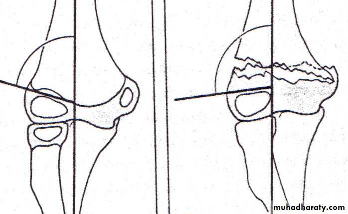 fracture around the elbow in childrin