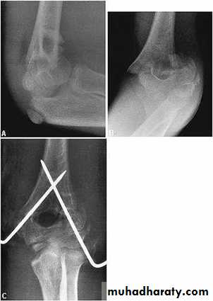 fracture around the elbow in childrin