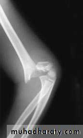 fracture around the elbow in childrin