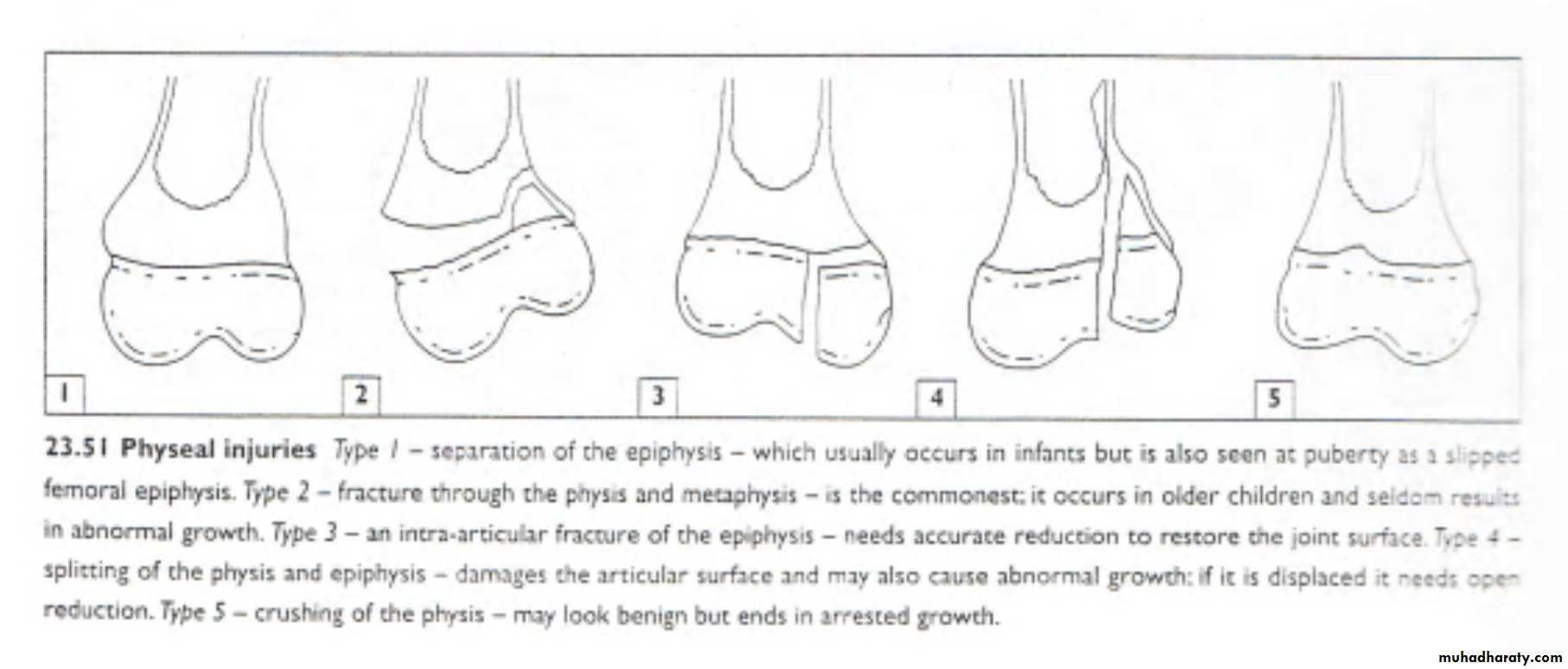 Complications of the fractures