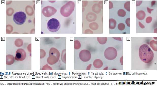 Hemolytic anemia