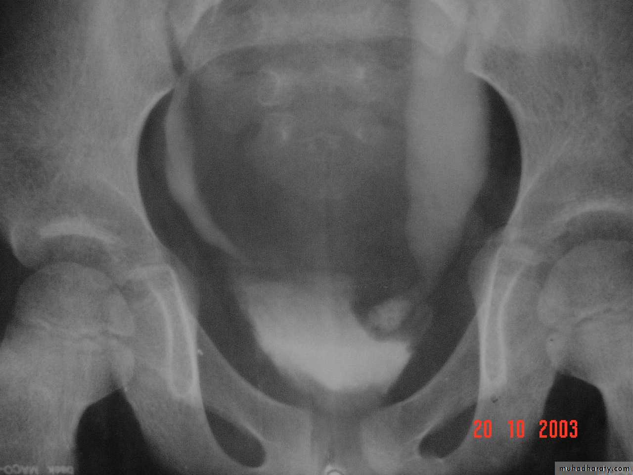 urinary tract imaging(films)