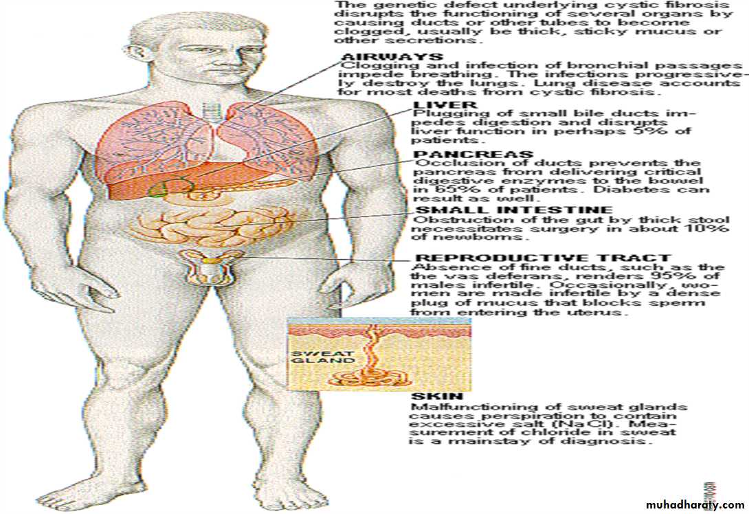 coaeliac diseas