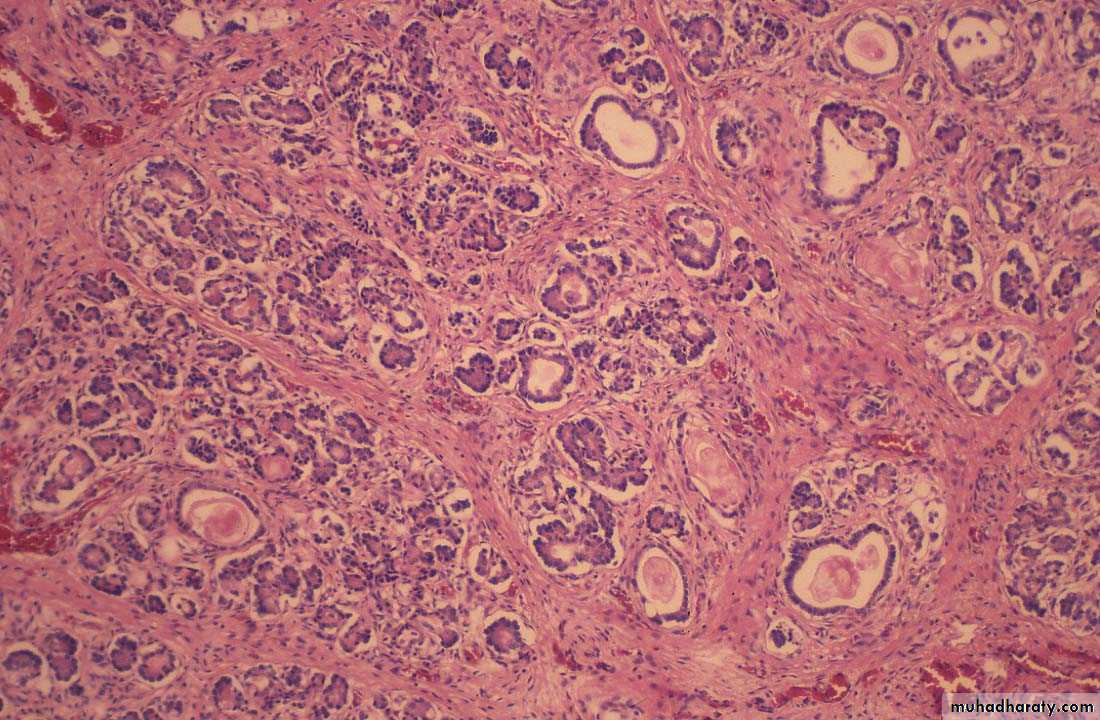 coaeliac diseas