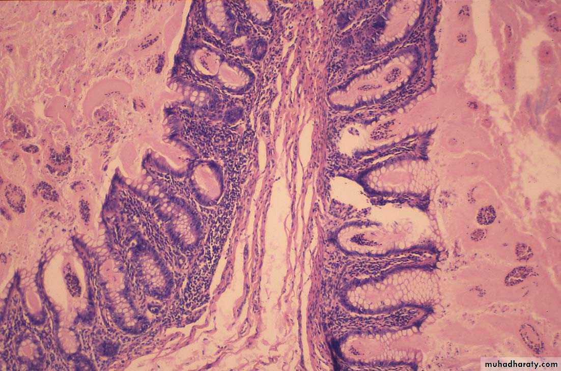 coaeliac diseas