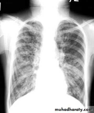 coaeliac diseas
