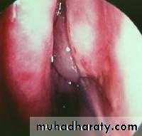 coaeliac diseas
