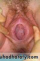 Amenorrhea