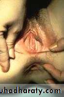 Amenorrhea