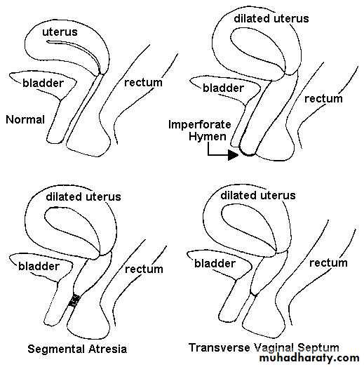 Amenorrhea