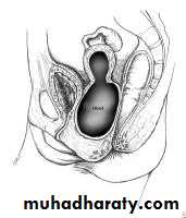 Amenorrhea