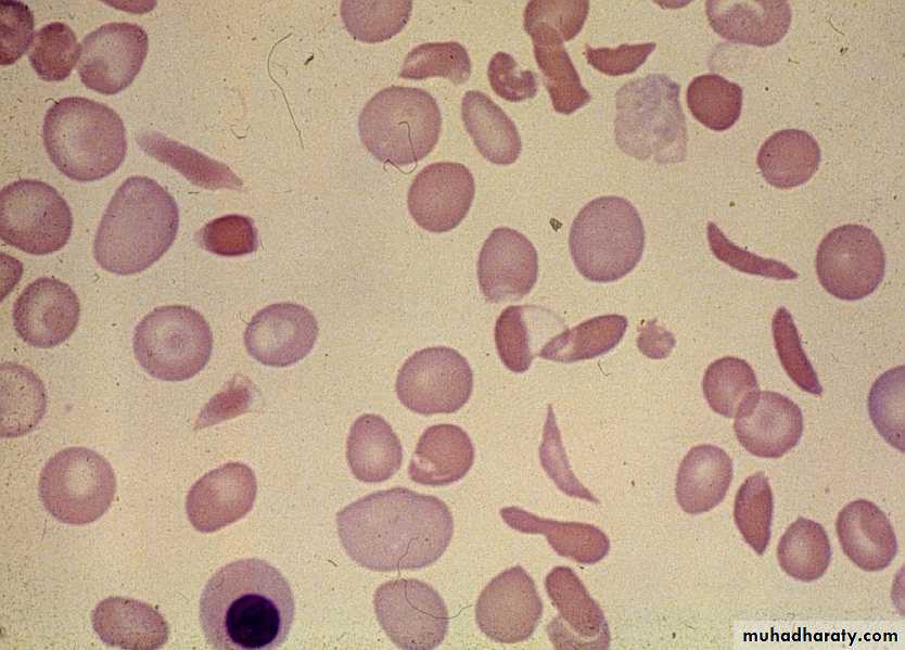 HEMOLYTIC DESORDERS