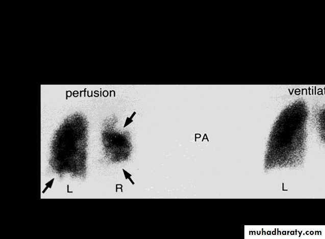 HEMOLYTIC DESORDERS