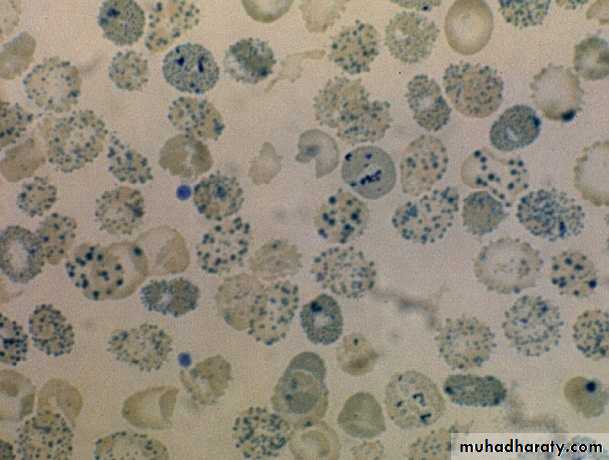 HEMOLYTIC DESORDERS