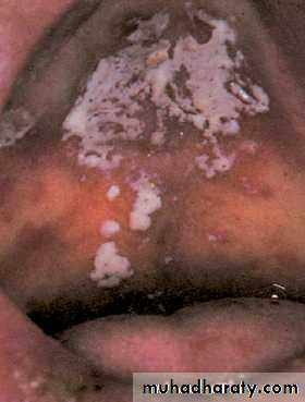 Mouth ulcer