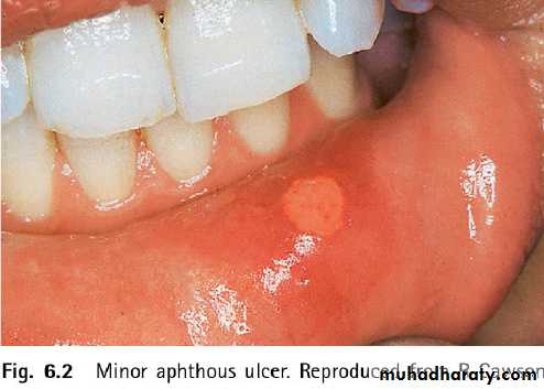 Mouth ulcer