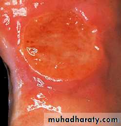 Mouth ulcer