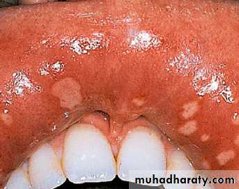 Mouth ulcer