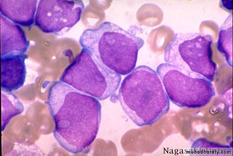ACUTE LEUKEMIA
