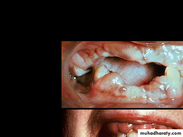 ACUTE LEUKEMIA