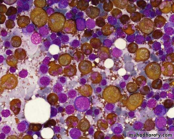 ACUTE LEUKEMIA