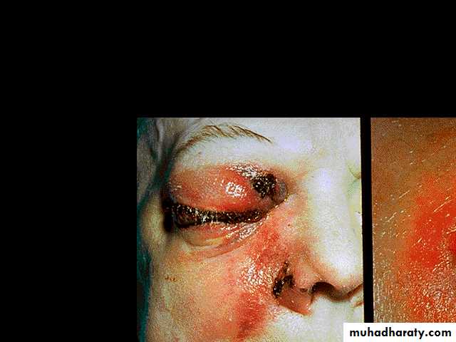 ACUTE LEUKEMIA