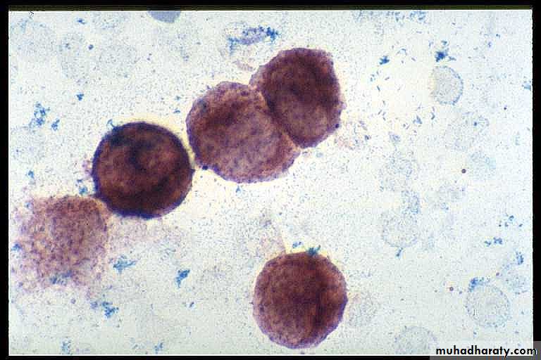 ACUTE LEUKEMIA
