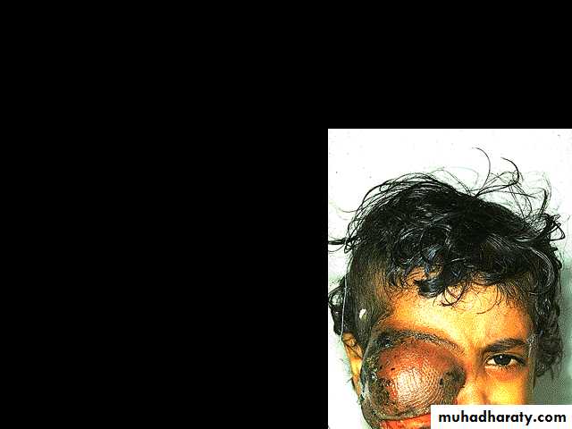 ACUTE LEUKEMIA