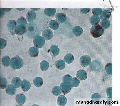 ACUTE LEUKEMIA