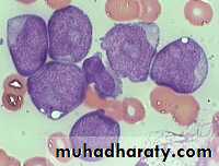ACUTE LEUKEMIA