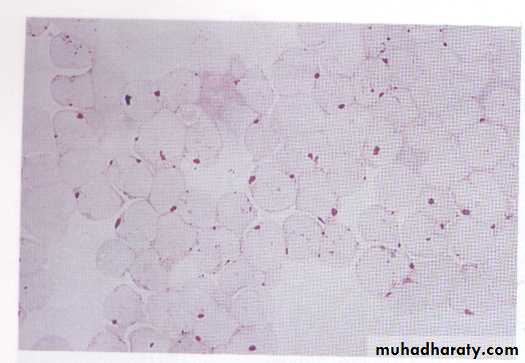 ACUTE LEUKEMIA