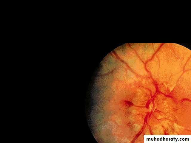 ACUTE LEUKEMIA