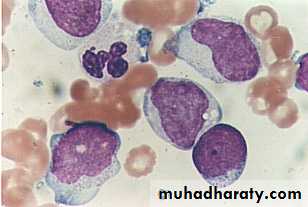 ACUTE LEUKEMIA
